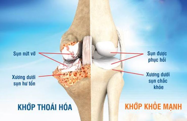 Thoái hóa khớp: dấu hiệu, nguyên nhân, điều trị và cách phòng ngừa